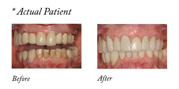 your new smile - Jean's before and after